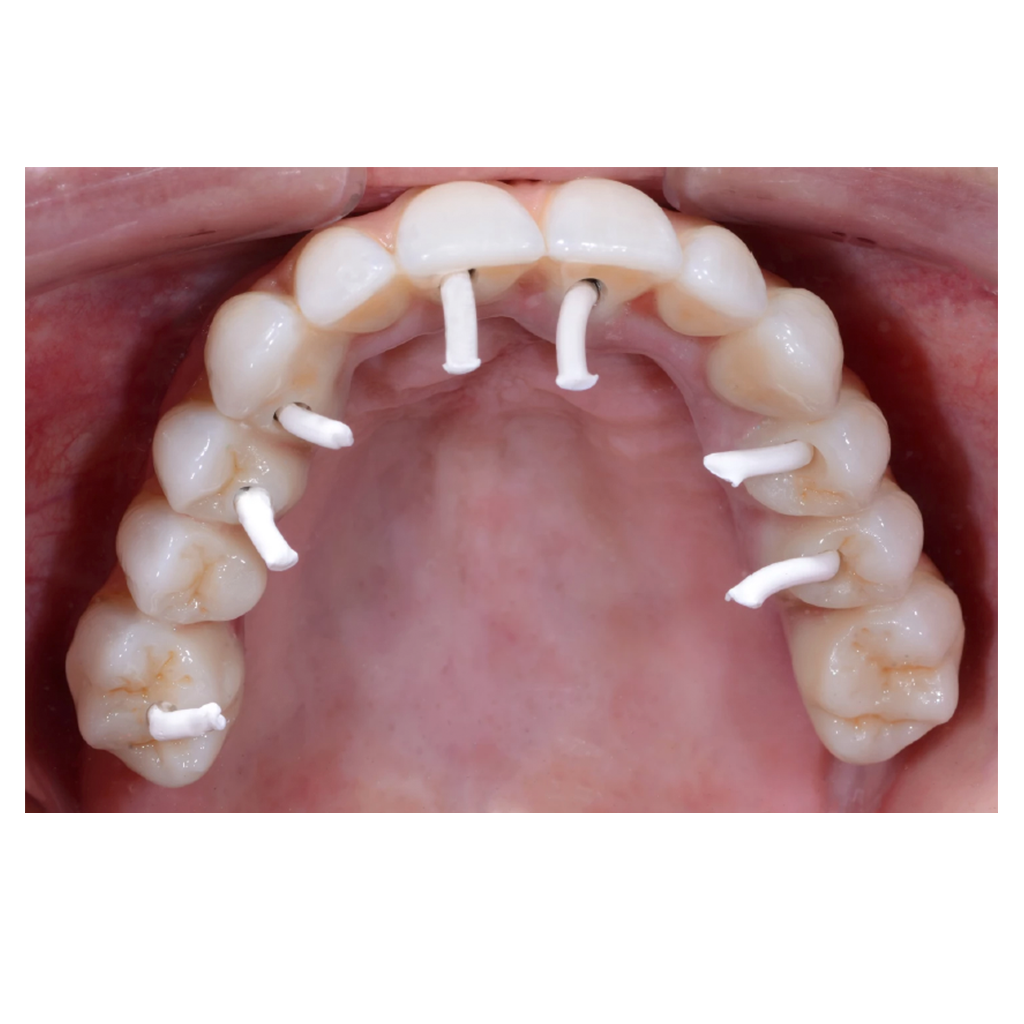 Instrument d'excavatrice à barrière FirstPlug