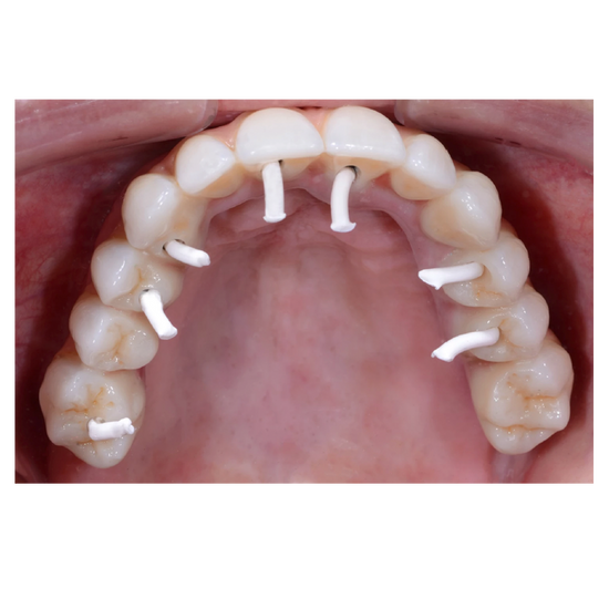 First Plug Light FirstPlug® System – Emerald Dental Works